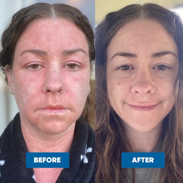 MooGoo Pink Eczema Cream - Image 3